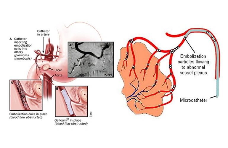 Gastrointestinal interventions 2n